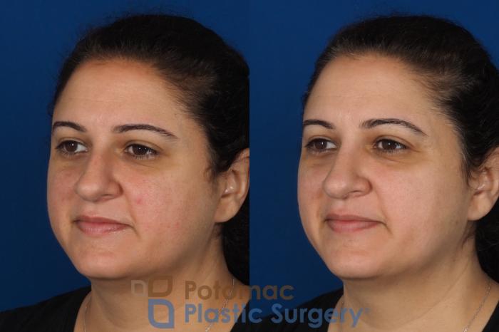 Before & After Rhinoplasty - Medical Case 287 Left Oblique View in Washington, DC