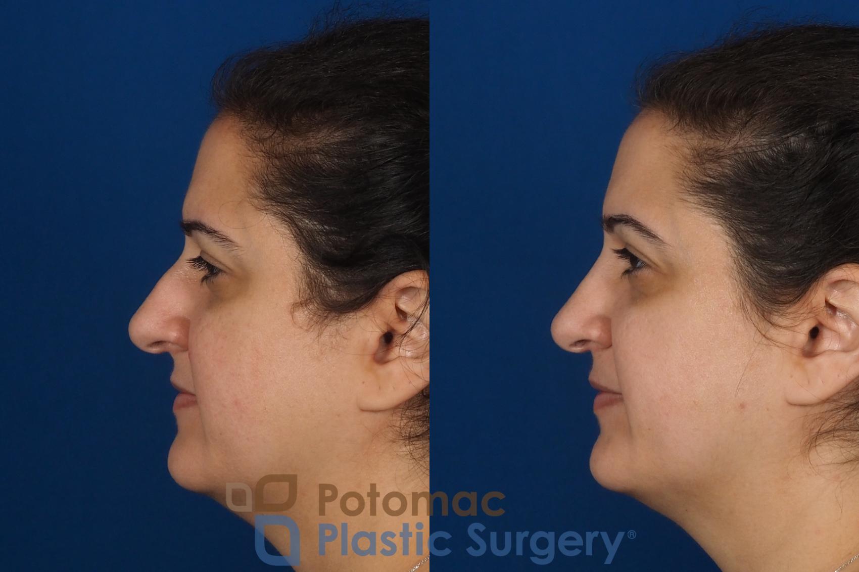 Before & After Rhinoplasty - Cosmetic Case 287 Left Side View in Washington, DC