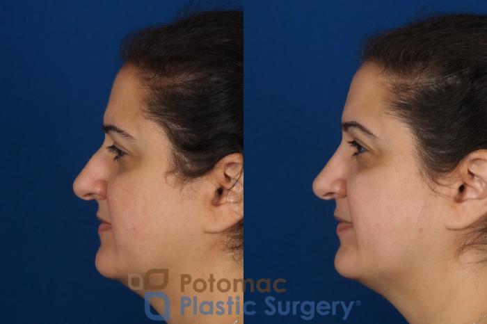 Before & After Rhinoplasty - Cosmetic Case 287 Left Side View in Arlington, VA & Washington, DC