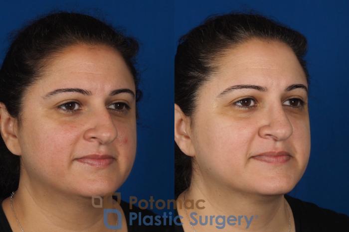 Before & After Rhinoplasty - Cosmetic Case 287 Right Oblique View in Arlington, VA & Washington, DC