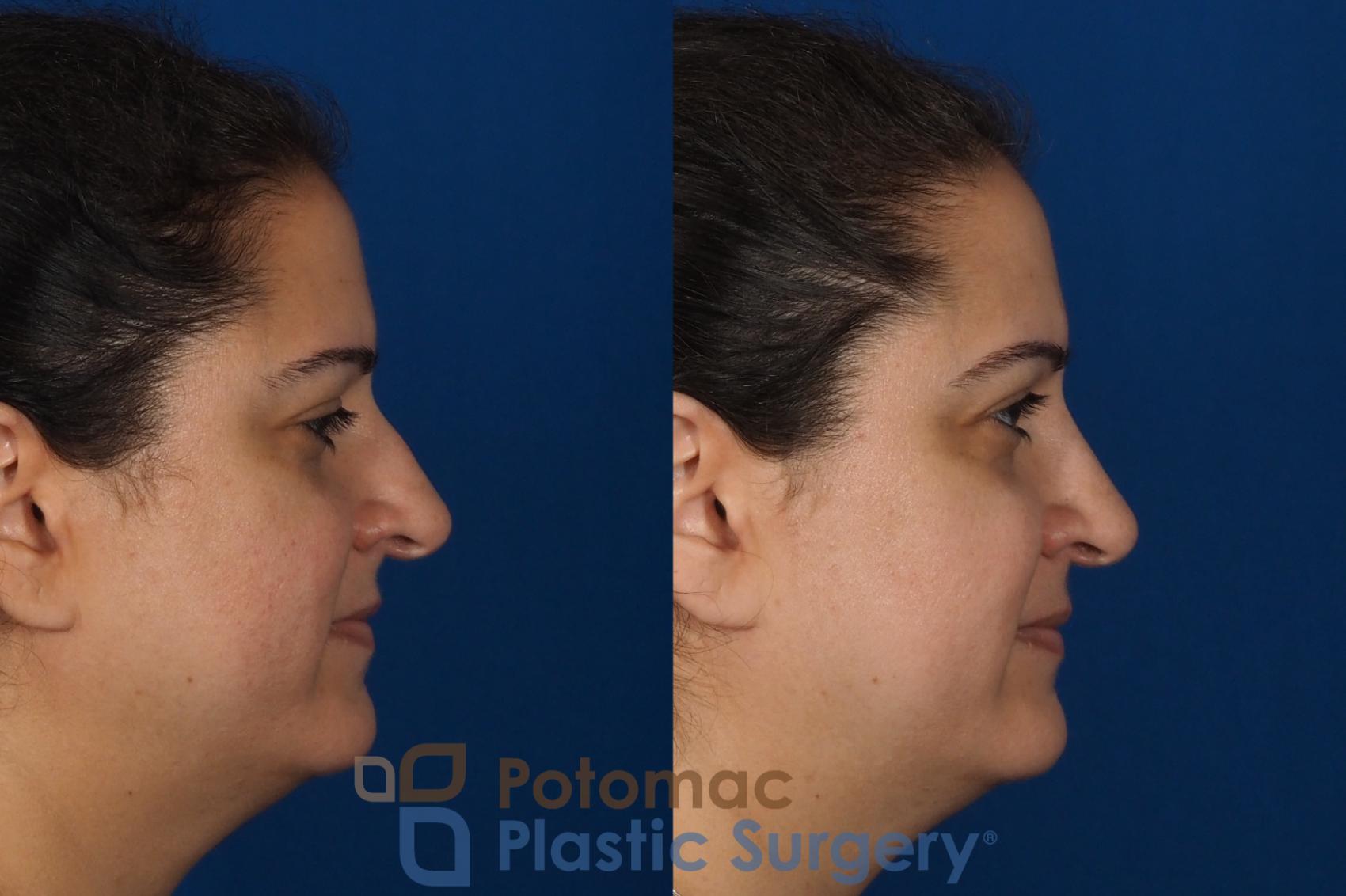 Before & After Rhinoplasty - Cosmetic Case 287 Right Side View in Washington, DC