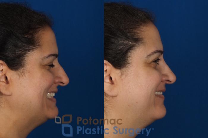 Before & After Rhinoplasty - Medical Case 287 Right Side - Smiling View in Washington, DC
