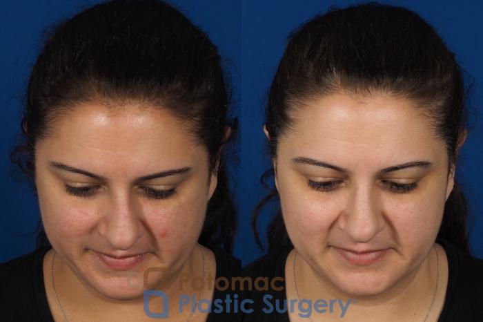 Before & After Rhinoplasty - Cosmetic Case 287 Top View in Arlington, VA & Washington, DC