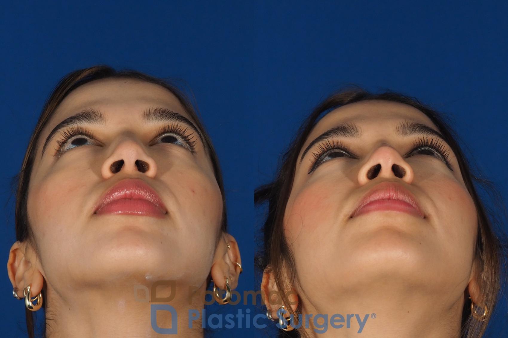 Before & After Rhinoplasty - Cosmetic Case 288 Bottom View in Washington, DC