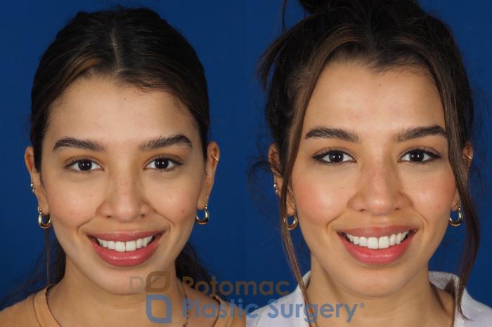 Before & After Rhinoplasty - Cosmetic Case 288 Front - Smiling View in Washington, DC