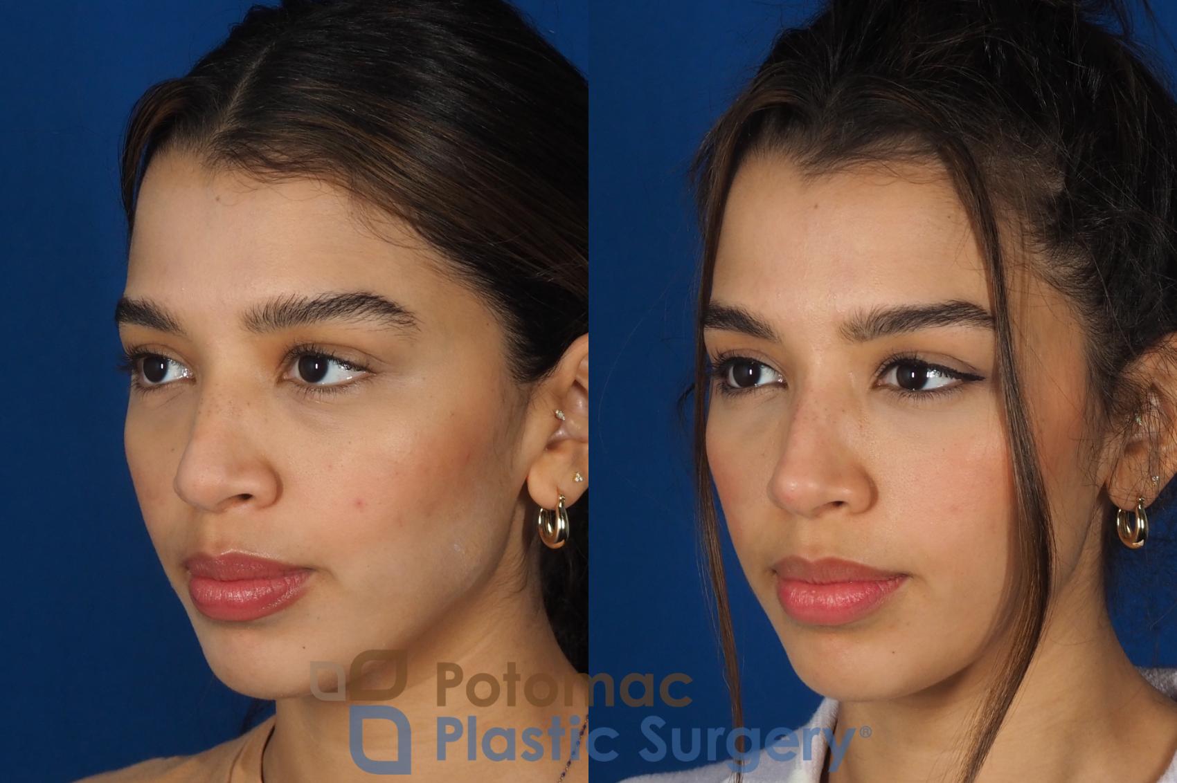 Before & After Rhinoplasty - Cosmetic Case 288 Left Oblique View in Washington, DC