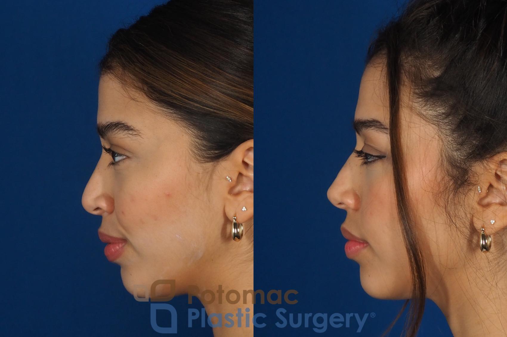 Before & After Rhinoplasty - Cosmetic Case 288 Left Side View in Washington, DC