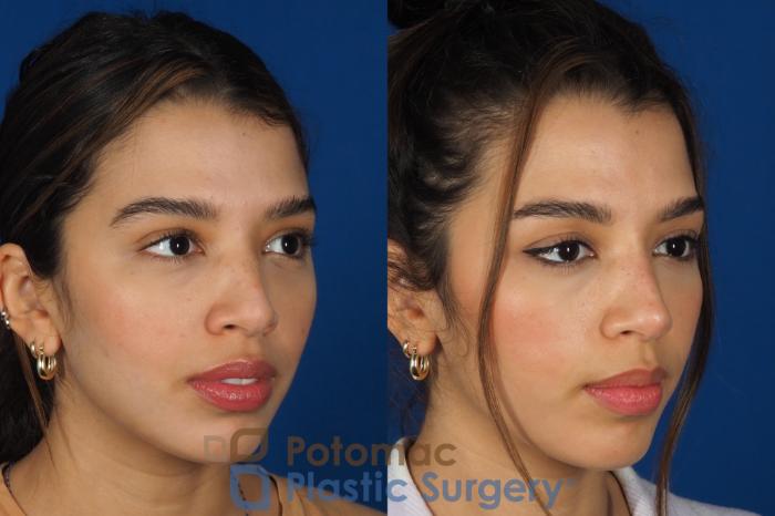 Before & After Rhinoplasty - Cosmetic Case 288 Right Oblique View in Washington, DC