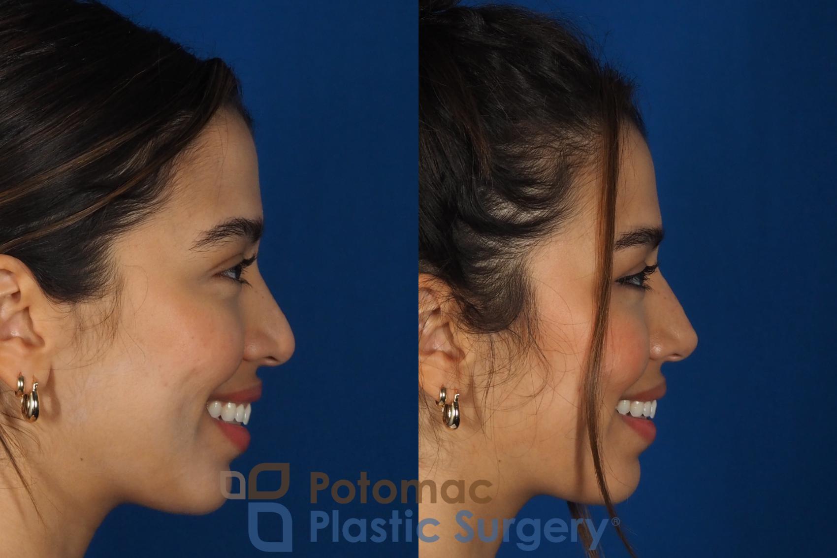 Before & After Rhinoplasty - Cosmetic Case 288 Right Side - Smiling View in Washington, DC