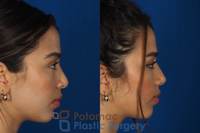 Before & After Rhinoplasty - Cosmetic Case 288 Right Side View in Washington, DC