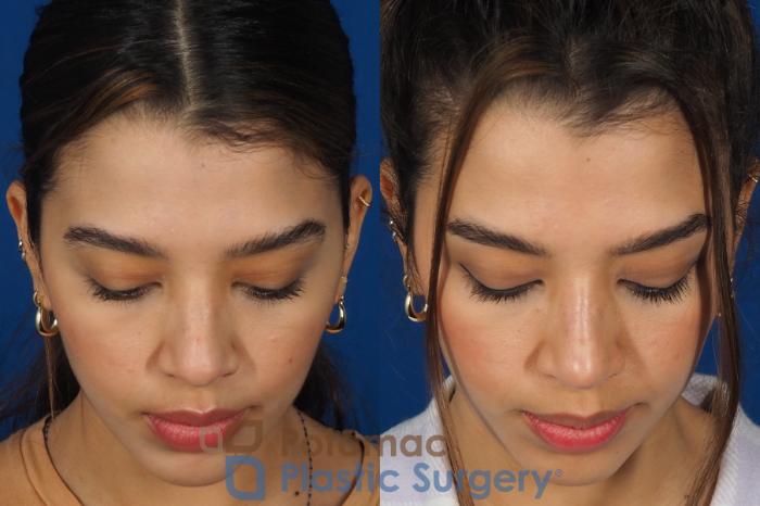 Before & After Rhinoplasty - Cosmetic Case 288 Top View in Washington, DC