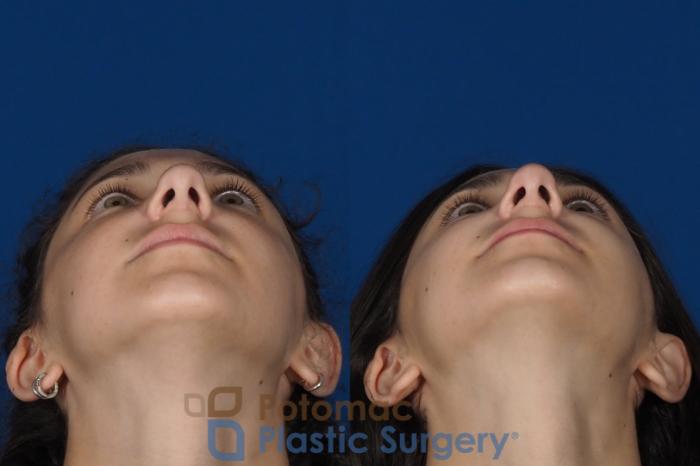 Before & After Rhinoplasty - Cosmetic Case 289 Bottom View in Washington DC & Arlington , DC
