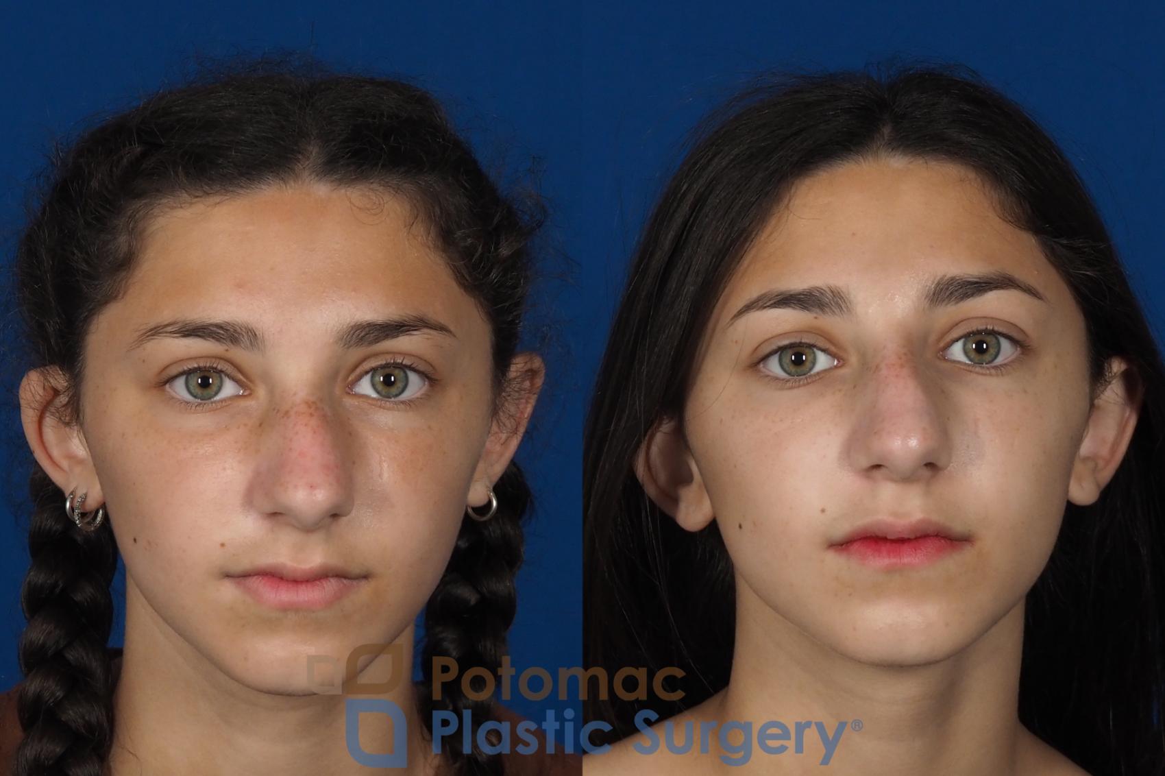 Before & After Dermal Fillers Case 289 Front View in Washington DC & Arlington , DC