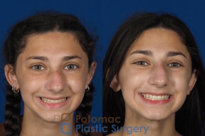 Before & After Rhinoplasty - Cosmetic Case 289 Front - Smiling View in Washington DC & Arlington , DC