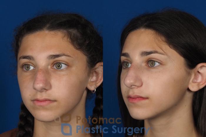 Before & After Rhinoplasty - Cosmetic Case 289 Left Oblique View in Washington DC & Arlington , DC