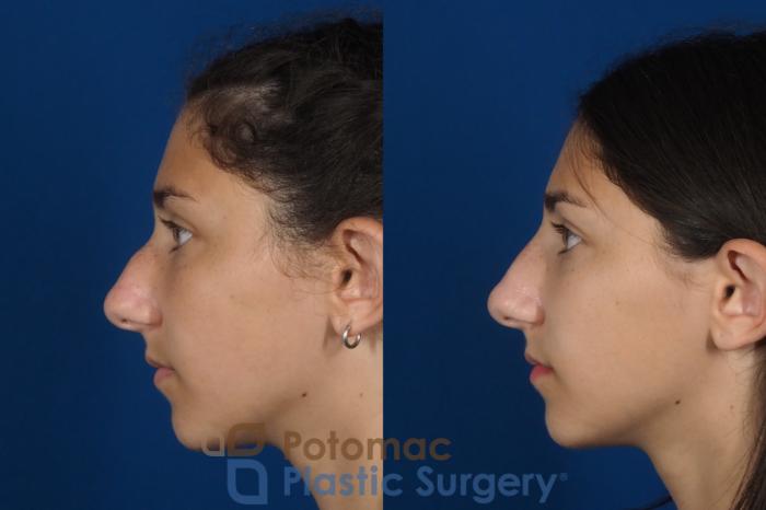 Before & After Rhinoplasty - Cosmetic Case 289 Left Side View in Washington DC & Arlington , DC