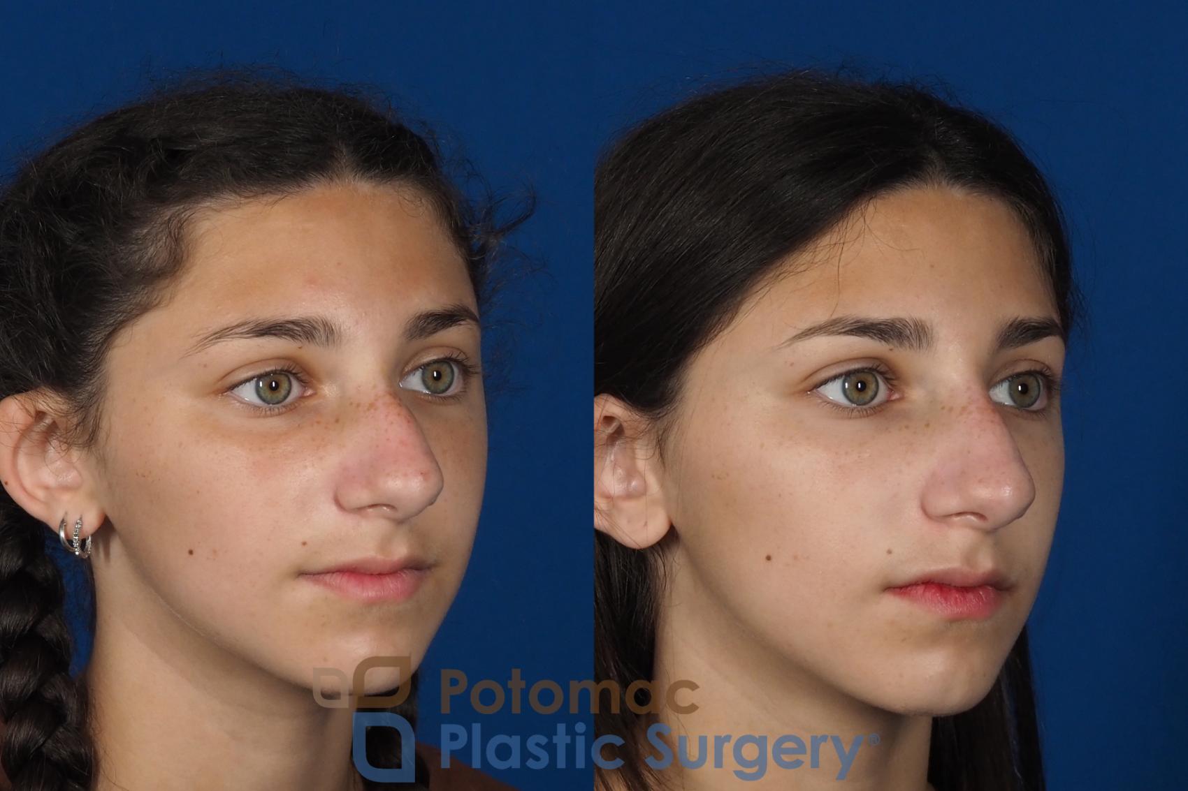 Before & After Rhinoplasty - Cosmetic Case 289 Right Oblique View in Washington DC & Arlington , DC