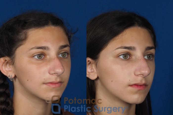Before & After Rhinoplasty - Cosmetic Case 289 Right Oblique View in Washington DC & Arlington , DC
