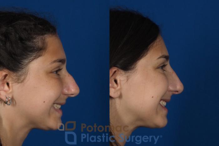 Before & After Rhinoplasty - Cosmetic Case 289 Right Side - Smiling View in Washington DC & Arlington , DC