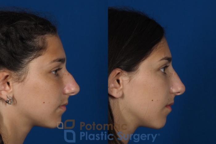 Before & After Rhinoplasty - Cosmetic Case 289 Right Side View in Washington DC & Arlington , DC