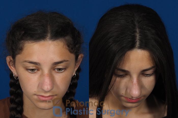 Before & After Rhinoplasty - Cosmetic Case 289 Top View in Washington DC & Arlington , DC
