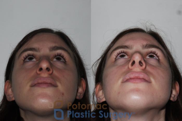 Before & After Rhinoplasty - Cosmetic Case 290 Bottom View in Washington DC & Arlington , DC