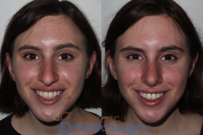 Before & After Rhinoplasty - Cosmetic Case 290 Front - Smiling View in Washington DC & Arlington , DC