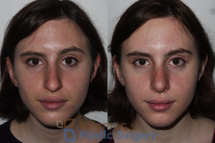 Before & After Rhinoplasty - Cosmetic Case 290 Front View in Washington DC & Arlington , DC