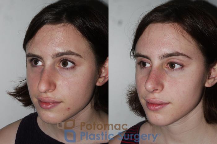 Before & After Rhinoplasty - Cosmetic Case 290 Left Oblique View in Washington DC & Arlington , DC