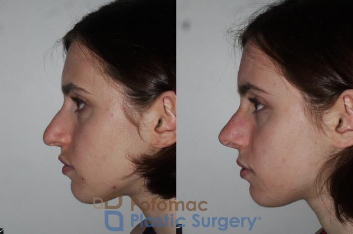 Before & After Rhinoplasty - Cosmetic Case 290 Left Side View in Washington DC & Arlington , DC