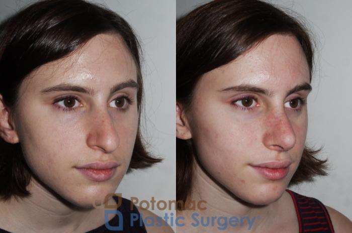 Before & After Rhinoplasty - Cosmetic Case 290 Right Oblique View in Washington DC & Arlington , DC