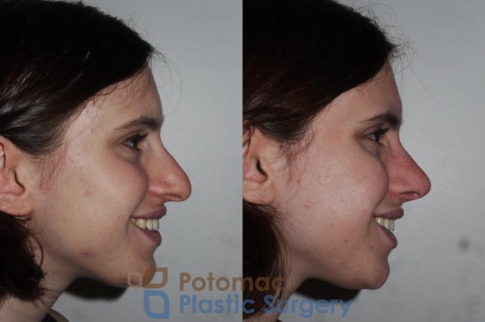 Before & After Rhinoplasty - Cosmetic Case 290 Right Side - Smiling View in Washington DC & Arlington , DC