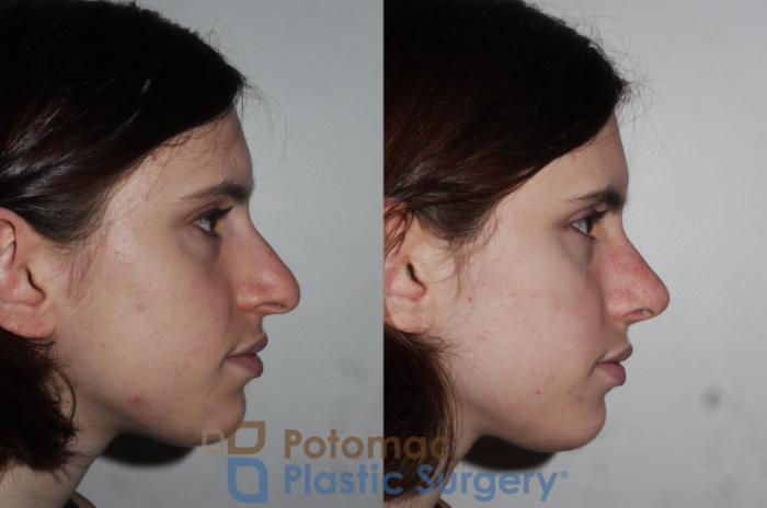 Before & After Rhinoplasty - Cosmetic Case 290 Right Side View in Washington DC & Arlington , DC