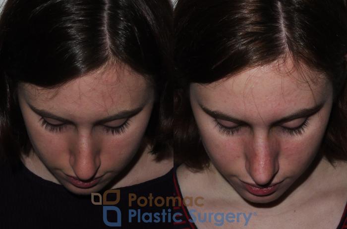 Before & After Rhinoplasty - Cosmetic Case 290 Top View in Washington DC & Arlington , DC