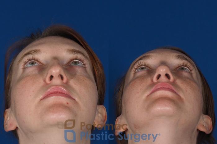 Before & After Rhinoplasty - Medical Case 291 Bottom View in Washington DC & Arlington , DC