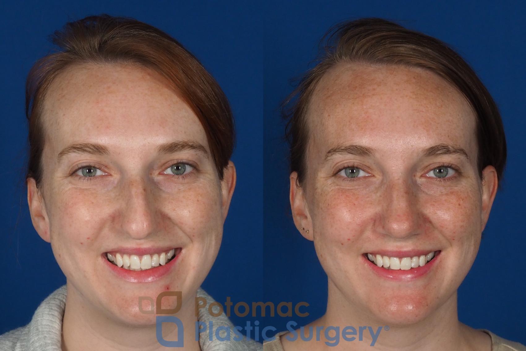 Before & After Rhinoplasty - Cosmetic Case 291 Front - Smiling View in Washington DC & Arlington , DC
