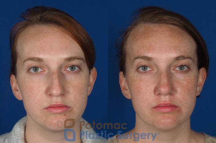 Before & After Rhinoplasty - Cosmetic Case 291 Front View in Arlington, VA & Washington, DC