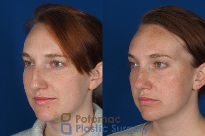 Before & After Rhinoplasty - Cosmetic Case 291 Left Oblique View in Arlington, VA & Washington, DC