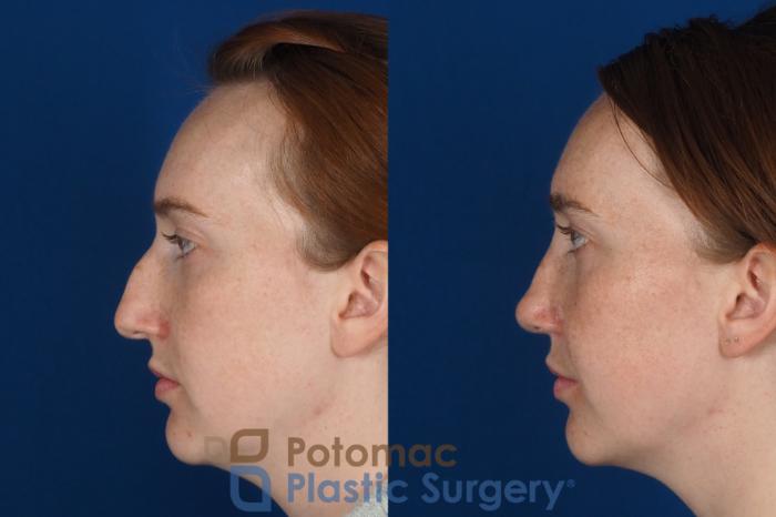Before & After Rhinoplasty - Cosmetic Case 291 Left Side View in Arlington, VA & Washington, DC