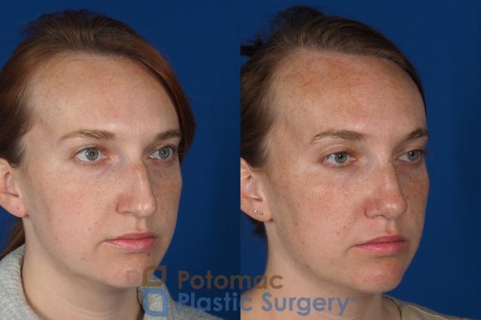 Before & After Rhinoplasty - Cosmetic Case 291 Right Oblique View in Arlington, VA & Washington, DC