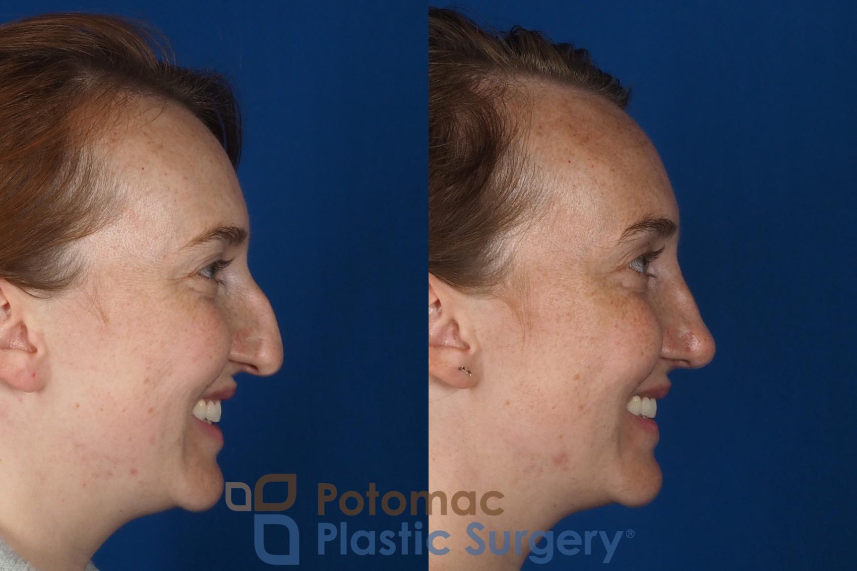 Before & After Rhinoplasty - Medical Case 291 Right Side - Smiling View in Washington, DC