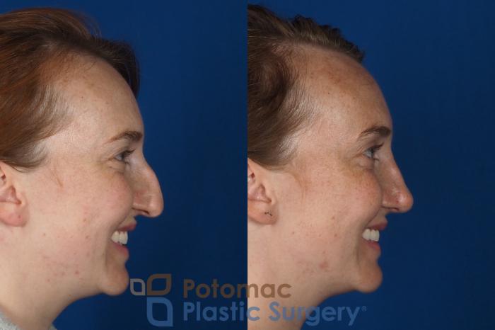 Before & After Rhinoplasty - Cosmetic Case 291 Right Side - Smiling View in Arlington, VA & Washington, DC
