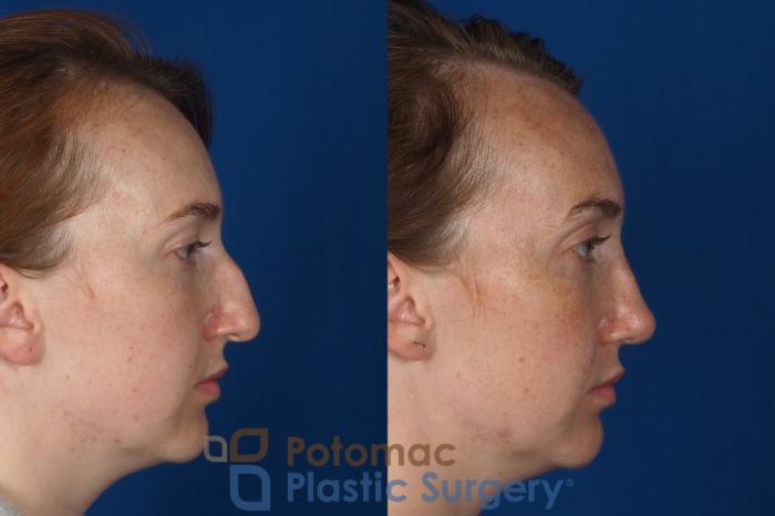 Before & After Rhinoplasty - Cosmetic Case 291 Right Side View in Arlington, VA & Washington, DC