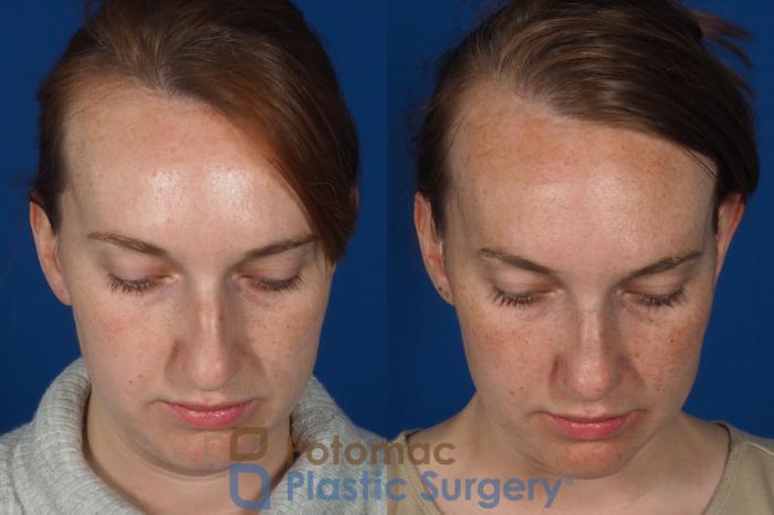 Before & After Rhinoplasty - Cosmetic Case 291 Top View in Arlington, VA & Washington, DC
