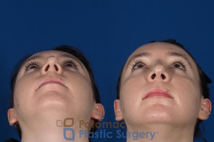 Before & After Rhinoplasty - Cosmetic Case 294 Bottom View in Washington DC & Arlington , DC