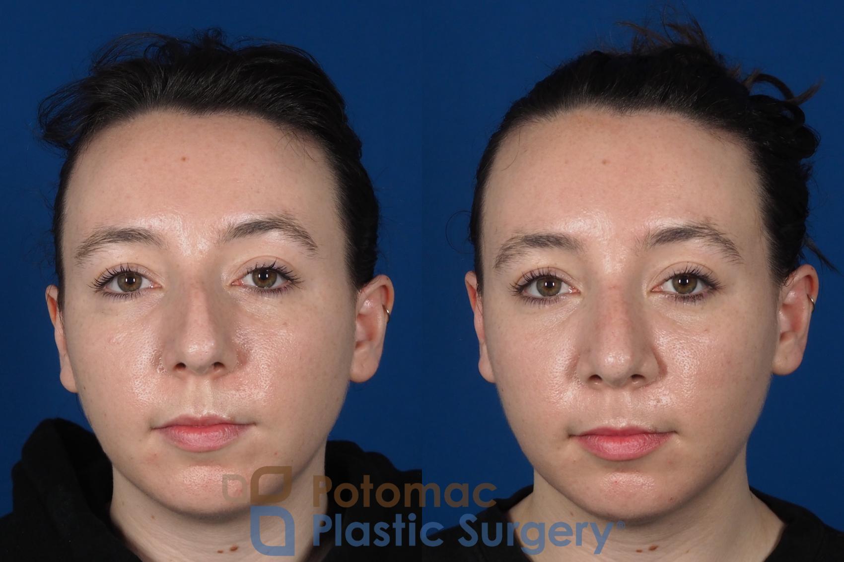 Before & After Rhinoplasty - Medical Case 294 Front View in Washington DC & Arlington , DC