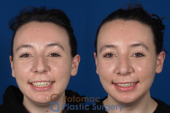 Before & After Rhinoplasty - Cosmetic Case 294 Front - Smiling View in Washington DC & Arlington , DC