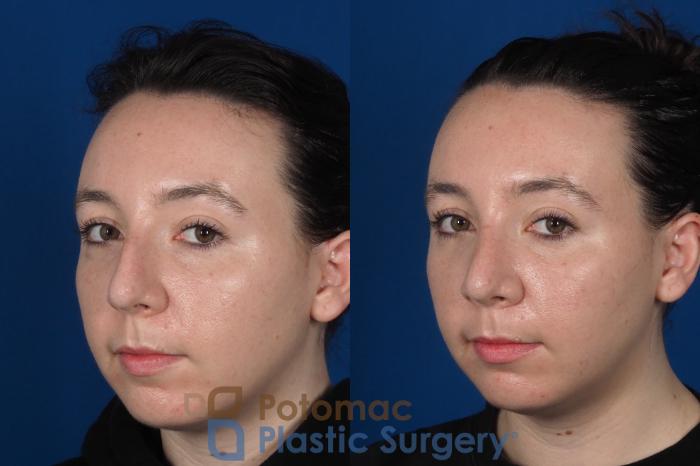 Before & After Rhinoplasty - Medical Case 294 Left Oblique 2 View in Washington DC & Arlington , DC