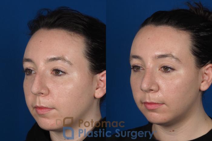 Before & After Rhinoplasty - Cosmetic Case 294 Left Oblique View in Washington DC & Arlington , DC