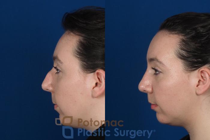 Before & After Rhinoplasty - Cosmetic Case 294 Left Side View in Washington DC & Arlington , DC